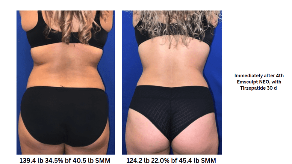 glp 1 microdose results Microdosing & EmSculpt Neo, Visible Body Transformation